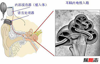 人造耳蜗多少钱 为什么这么贵498 / 作者:网上的人生 / 帖子ID:52983