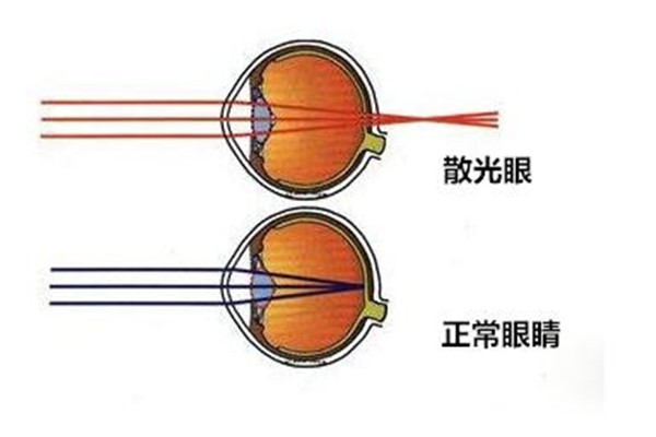 散光是怎么造成的 人为什么会发生散光115 / 作者:UFO爱好者 / 帖子ID:88981