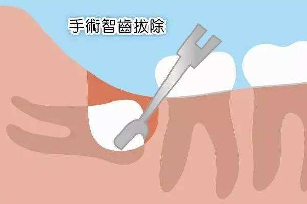 智齿不用拔的三种情况:智齿正常，智齿阻生，智齿没长出74 / 作者:UFO爱好者 / 帖子ID:78307