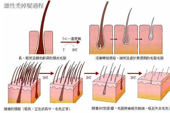 脱发是什么原因引起的?与遗传因素有关，预兆身体有疾病917 / 作者:UFO爱好者 / 帖子ID:77159